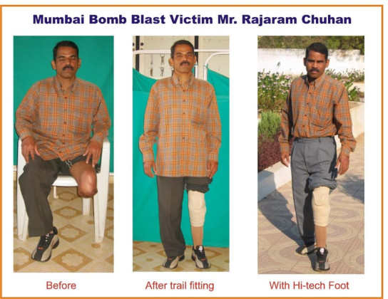 Mumbai Bomb Blast Patient